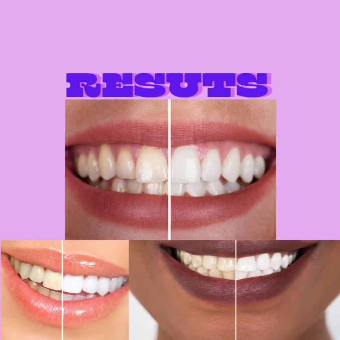 Lumero Purple Teeth Whitening Strips - 7/21 Whitening Sessions - Non Sensitive Teeth Whitening - Peroxide-Free