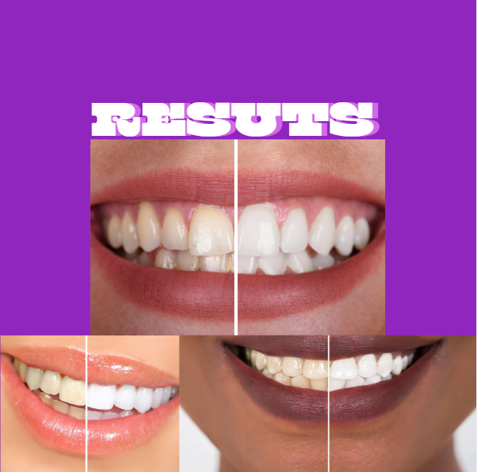 Lumero Purple Teeth Whitening Strips - 7/21 Whitening Sessions - Non Sensitive Teeth Whitening - Peroxide-Free