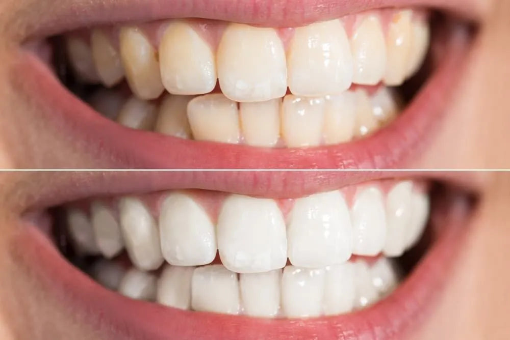 Lumero Purple Teeth Whitening Strips - 7/21 Whitening Sessions - Non Sensitive Teeth Whitening - Peroxide-Free
